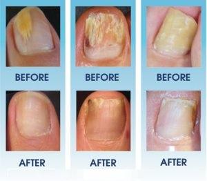 DETOXIFYING ANTIFUNGAL FOOT SPA