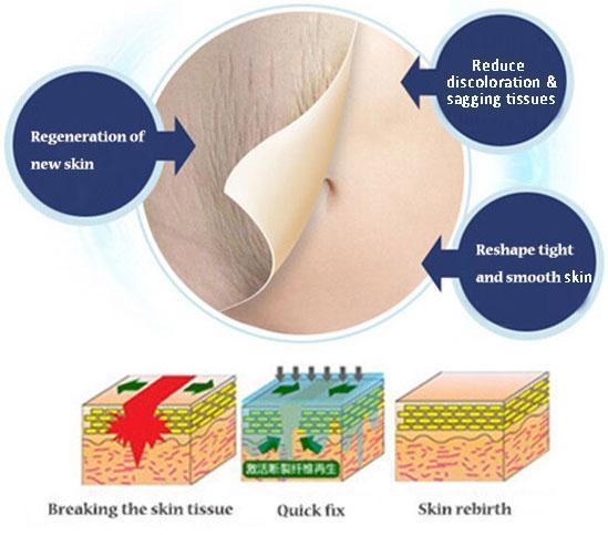 Anti Stretch Mark Cream