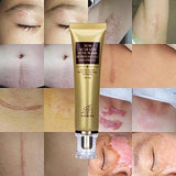 Acne Scar Remover Cream