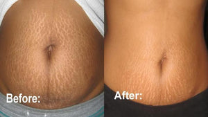 Anti Stretch Mark Cream