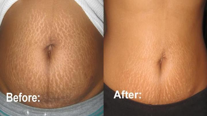 Anti Stretch Mark Cream